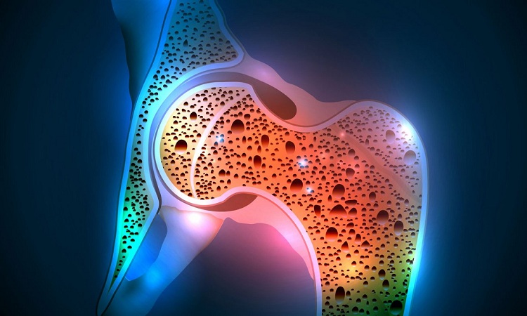  10 Mitos tentang Osteoporosis