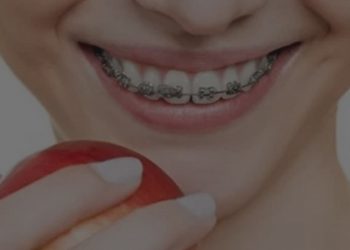 Beberapa Hal yang Perlu Dipahami dalam Perawatan Gigi